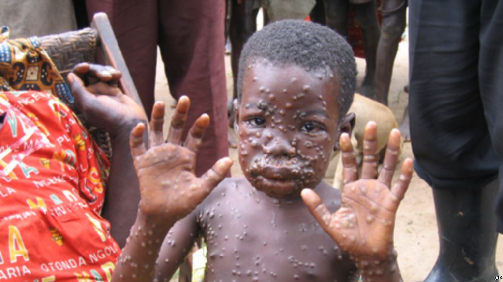 Image result for monkeypox